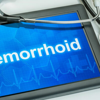 Best ways to manage hemorrhoids